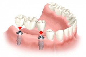 zubní implantáty - cena